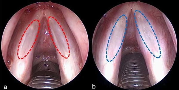 (좌측) 양측 성대의 점막이 안쪽으로 들러붙은 성대구증 환자의 수술 전 내시경 소견 (우측) 532nm 레이저를 이용한 성대구증 레이저 성대 성형술 시행 직후의 내시경 소견